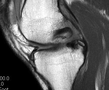 PCL Avulsion MRI